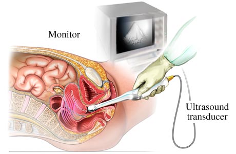 Transvaginal Ultrasound