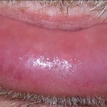 How to Treat a Swollen Lip