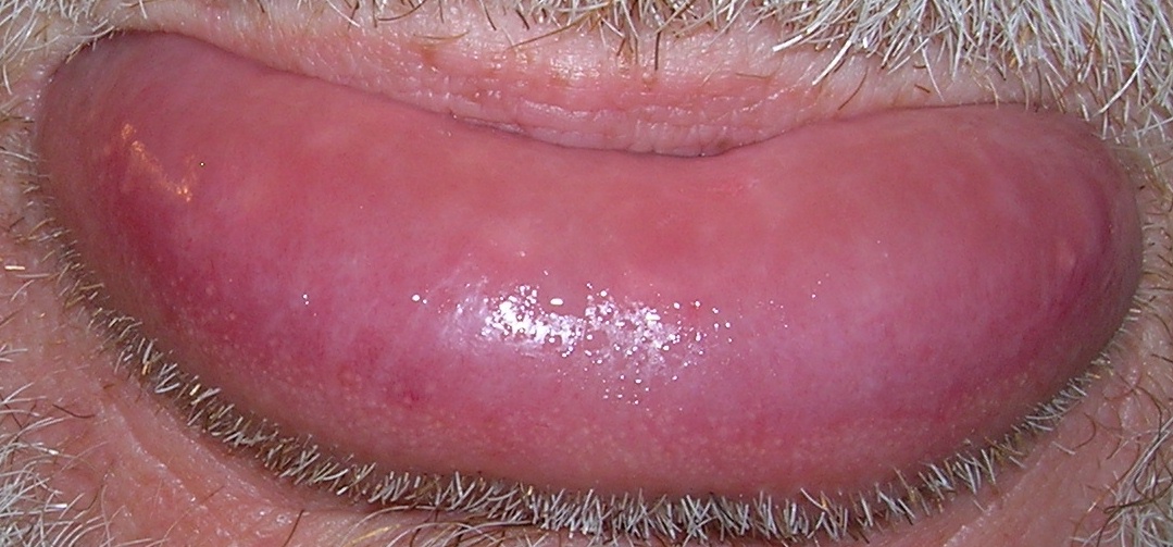 Treat a Swollen Lip