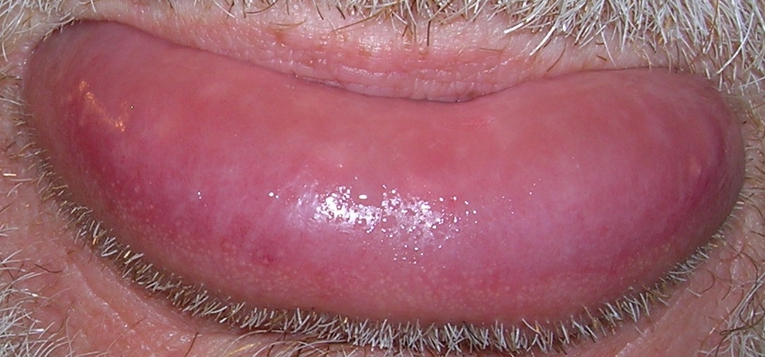 Inflamed lips - Dermatology - MedHelp