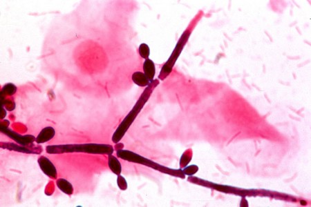 Yeast Infections