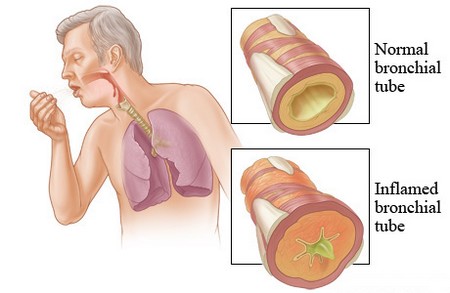 Acute Bronchitis