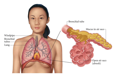 Pneumonia