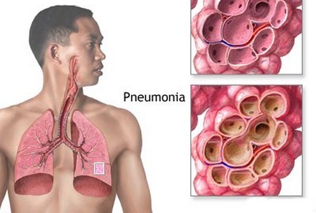 Pneumonia