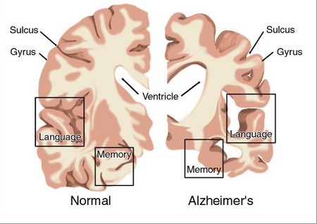 Alzheimer Disease