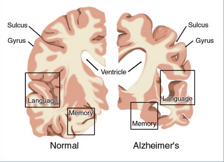 Alzheimers Disease