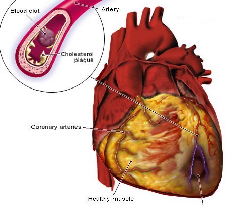 Angina Associated Heart Disease