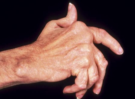 Arthritis