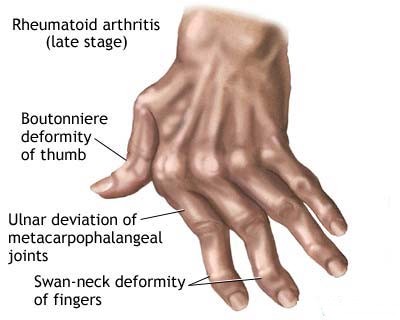 Arthritis