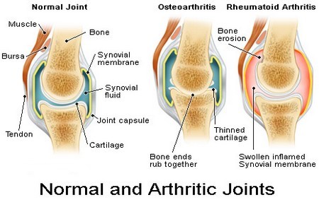 Arthritis