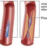 How to Prevent and Reverse Atherosclerosis 