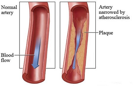 Atherosclerosis