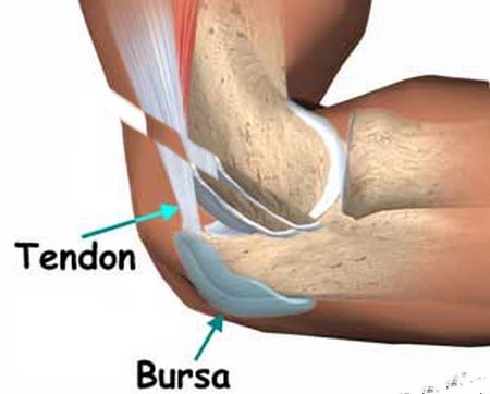 Bursitis