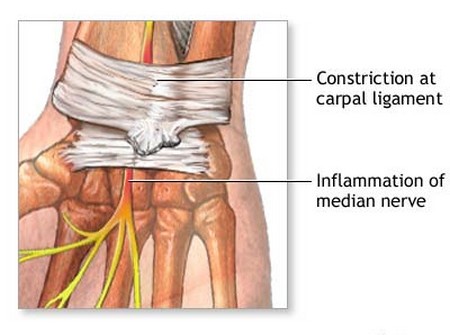 Carpal Tunnel 