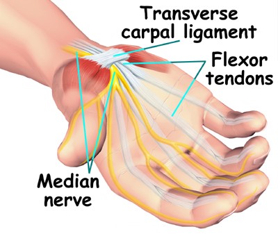 Carpal Tunnel Syndrome