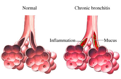 pathophysiology of hypokalemia schematic diagram