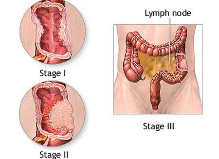 Colorectal Cancer