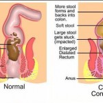 How to Treat Constipation 