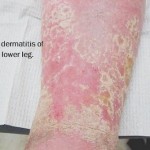 How to Treat Dermatitis