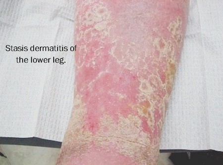 Dermatitis
