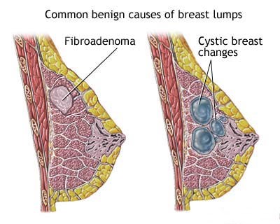 Fibrocystic Breast