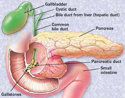 Gallstones