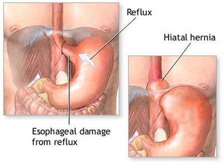 Gastroesophageal Reflux