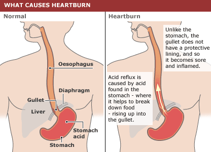 Heartburn