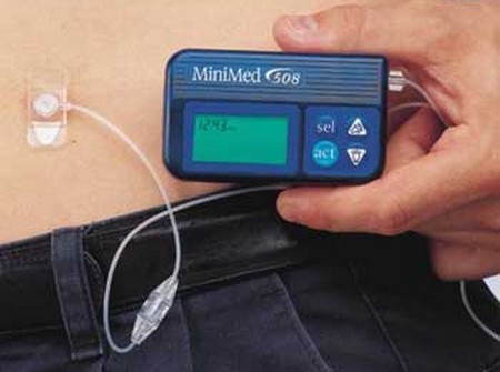 Insulin Infusion Pump