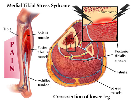 Leg Pain