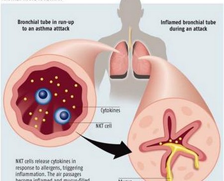 Long-Standing Asthma