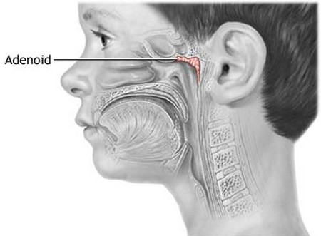 Manage Sinusitis Asthma