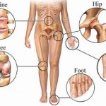 How to Treat Osteoarthritis 