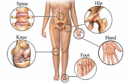 Osteoarthritis
