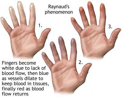Raynauds