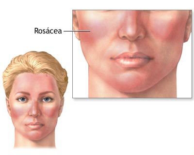 Rosacea