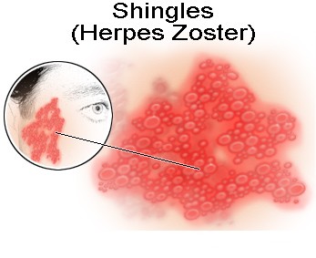 Shingles