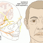 How to Treat Slurred Speech 
