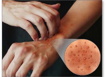 Stop Dermatitis
