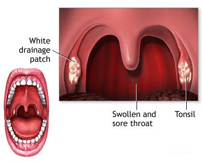 Strep Throat