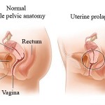 How to Treat Uterine Prolapse 