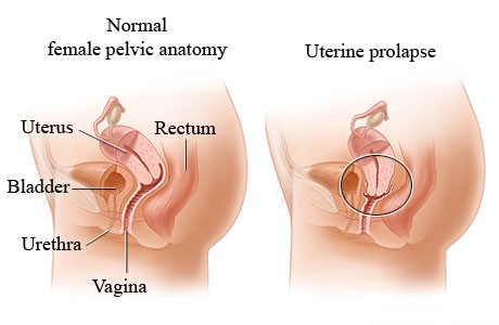 Uterine Prolapse