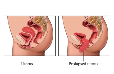 Uterine Prolapse