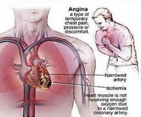 Angina Pectoris