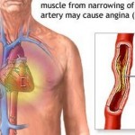 How to Treat Angina Pectoris Naturally 