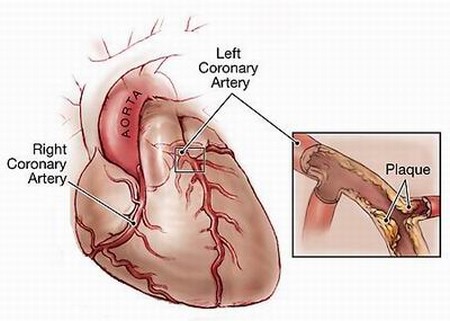 heart disease cartoon. heart disease cartoon. heart