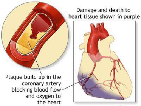 Coronary Heart