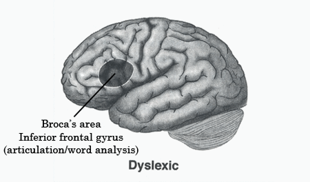 Dyslexia