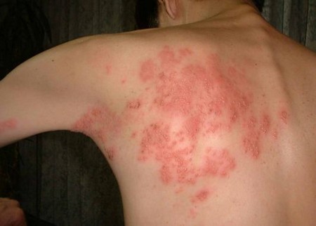 heat rash pictures in toddlers. heat rash pictures in
