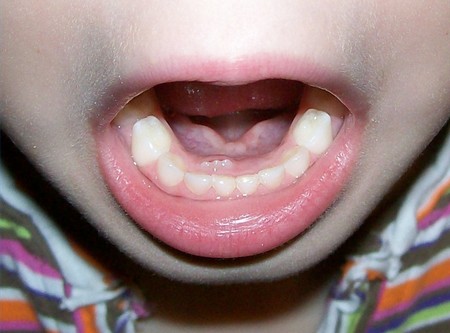 teething rash. attributed to teething but